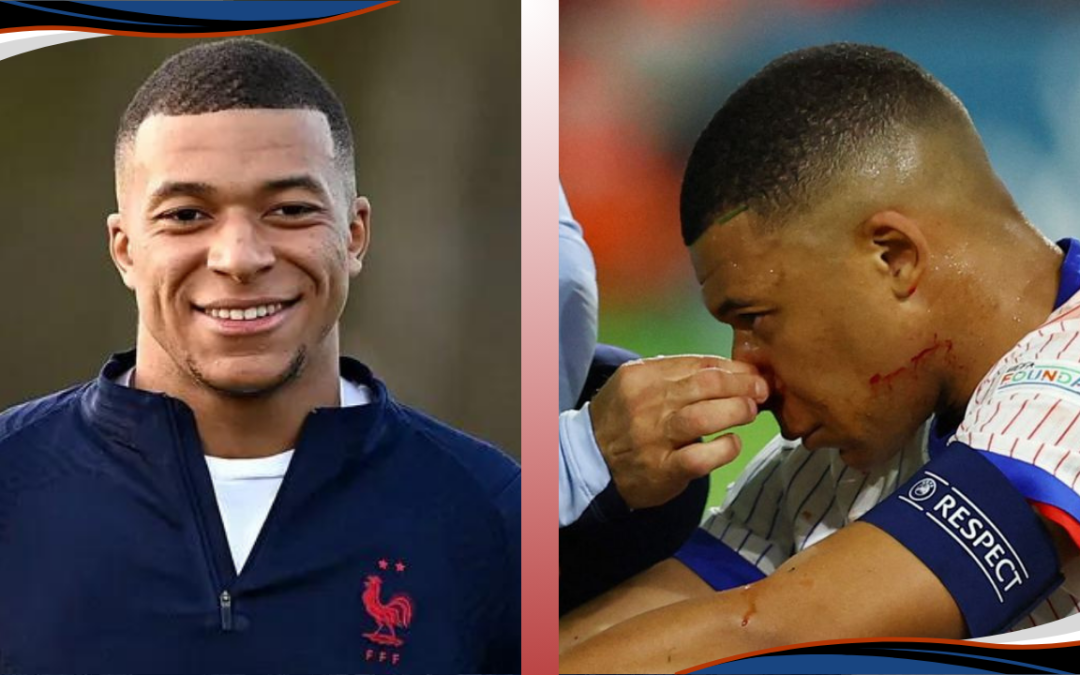 Kylian Mbappe Suffers Broken Nose in Euro 2024 Opener, No Immediate Surgery Needed